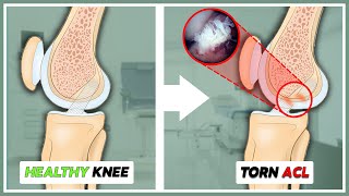 Torn ACL? Surgery vs. Conservative Treatment: What You Need to Know