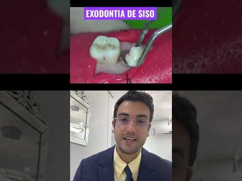 Vídeo: Vou ficar inconsciente durante a remoção do dente do siso?