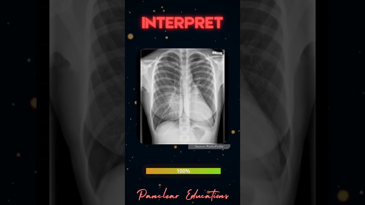 Radiology| XRAY Chest Findings|High Yield MCQs|NEET PG | INICET | MRB | PYQs 