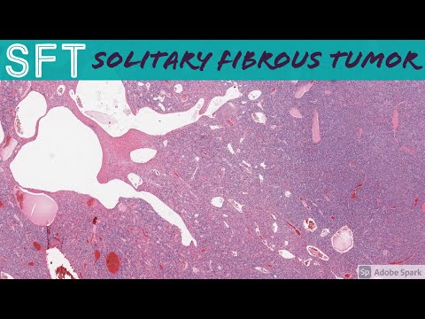 Solitary Fibrous Tumor (SFT) (formerly known as Hemangiopericytoma): 5-Minute Pathology Pearls