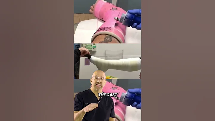 Achilles Rupture Cast: How Long? #shorts