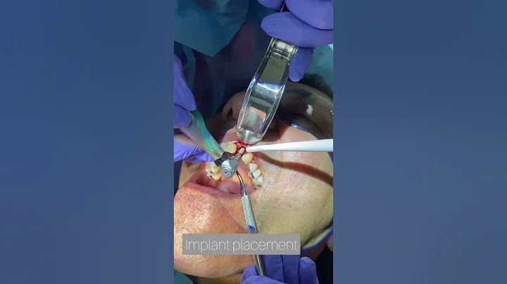 Immediate implant placement after extraction of a front tooth. #toothimplant #implantsurgery