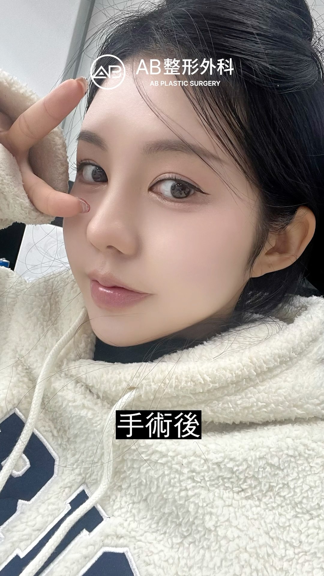 顴骨下顎全切！她的輪廓變V了 #shorts
