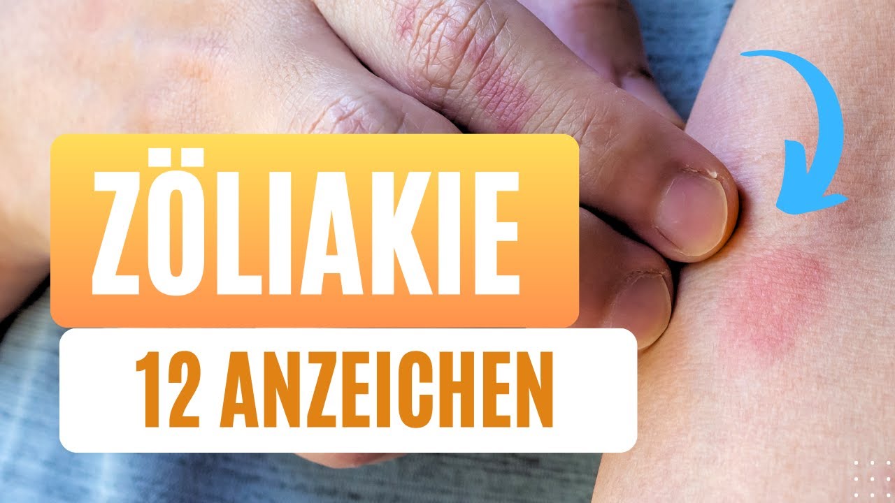 Du wirst dich wundern, welche Anzeichen bei Zliakie auftreten knnen.:12 (berraschende) Symptome! Du wirst dich wundern, welche Anzeichen bei Zliakie auftreten knnen.:12 (berraschende) Symptome!