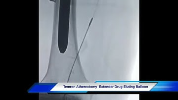 TemREN® Atherectomy with Extender® Drug-Eluting Balloon for In-Stent Restenosis | INVAMED