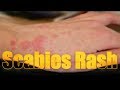 Scabies Rash: itchy, highly contagious skin disease | Usapang pangkalusugan