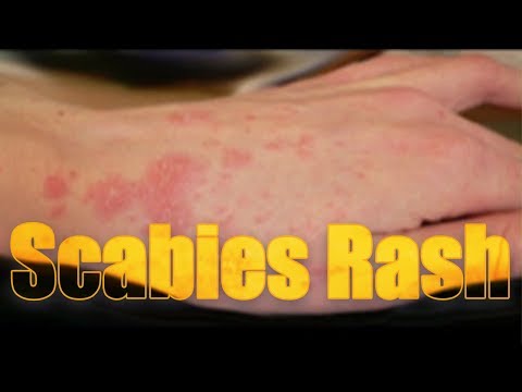 Video: Paano Magagamot ang Heat Rash: 14 Mga Hakbang (na may Mga Larawan)