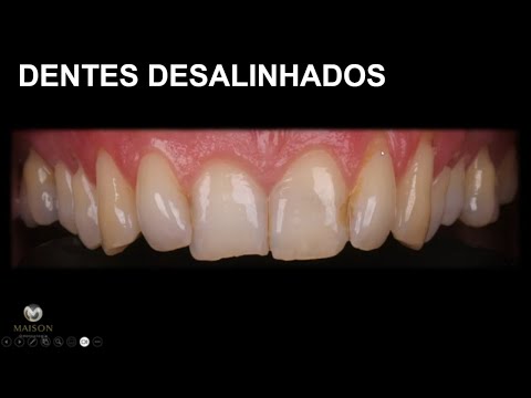 Vídeo: As facetas podem corrigir dentes tortos?