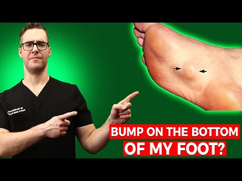 Video: Bump On Bottom Of Foot: To Svědí, žádná Bolest, Bolí Chodit A Další