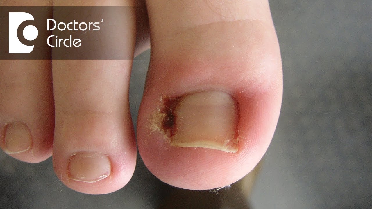 Hangnail & infected hangnail causes, symptoms, diagnosis & treatment