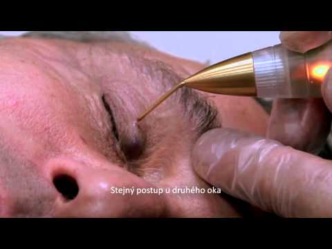 Jett Plasma Lift Medical - Eyelid wrinkles removal