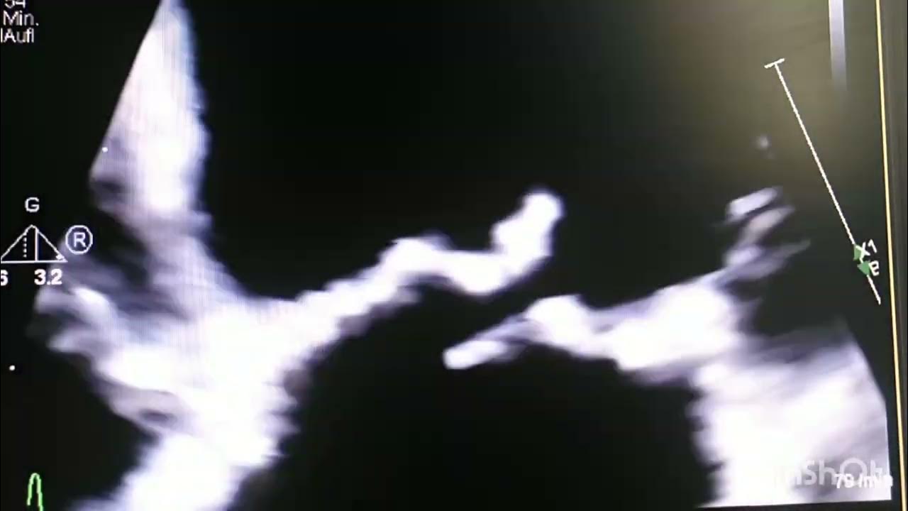 Coanda effect in a very severe wall hugger mitral regurgitation YouTube