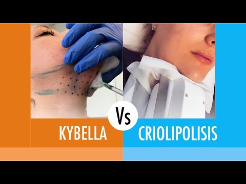 Vídeo: Kybella: Costo, Efectos Secundarios Y Qué Esperar