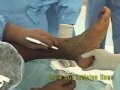 Transtibial Amputation Extended Flap and Bone Bridging - Skin/Flaps