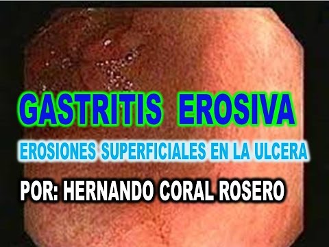Gastritis cronica antral se cura