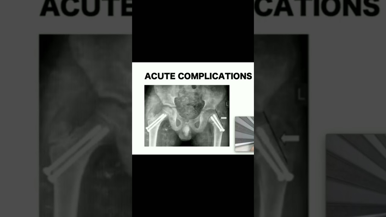 Acute Complications