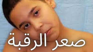 علاج صعر الرقبة|التواء الرقبة وعلاجها|Torticollis|Congenital torticollis|انحناء الرقبة عند الاطفال