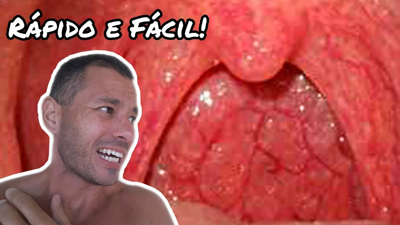 Como CURAR GARGANTA INFLAMADA da noite pro dia? - YouTube