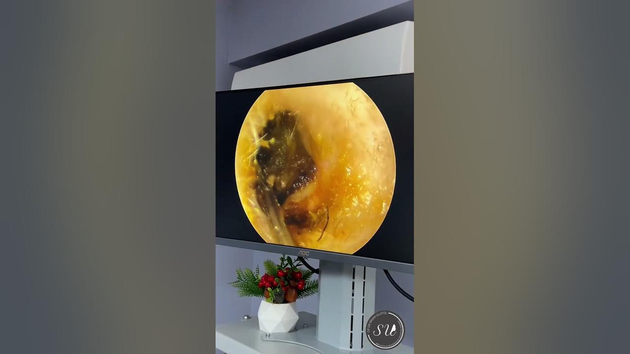 Earwax removal causing hearing loss by Dr Uluyol / Kulak kiri