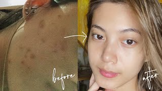 HOW I CLEARED MY SKIN (ACNE JOURNEY + SKINCARE ROUTINE 2020)