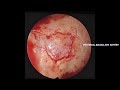 Endoscopic Juvenile Nasopharyngeal Angiofibroma
