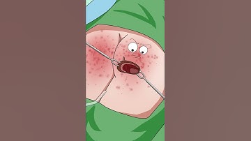 Thumbnail of 老爷子比达神还能忍Bedsore debridement