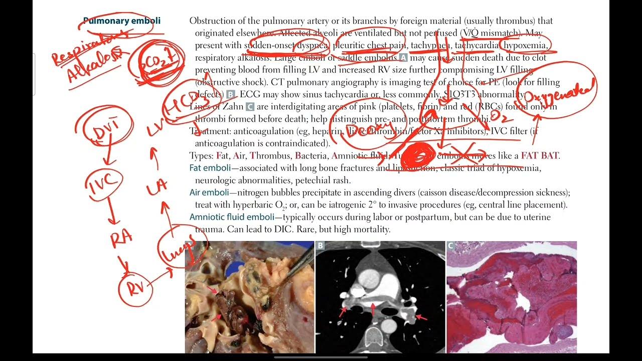 USMLE Step 1 Step 2 Ck Pulmonary Embolism Respiratory 13 usmle-step-1-step-2-ck-pulmonary-embolism-respiratory-13
