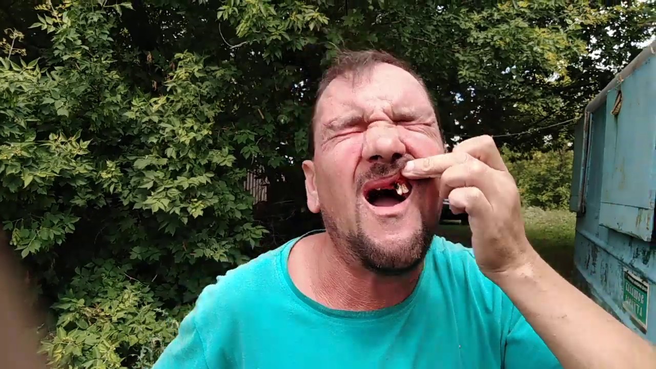 Как вырвать зуб самому. - YouTube