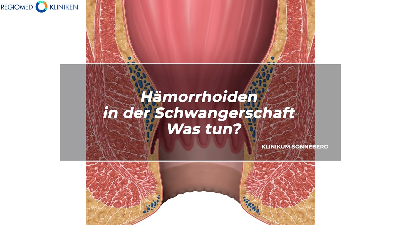 REGIOMED Kliniken: Hämorrhoiden in der Schwangerschaft - Was tun? - YouTube