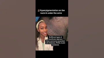 How To Get Rid Of Hyperpigmentation On The Neck And Under The Arms 