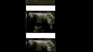 Babys Heart Beat 9w5d