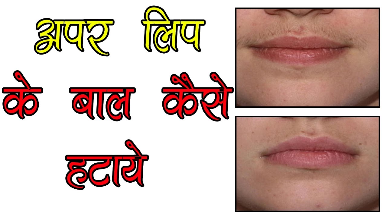 अपर लिप के बाल कैसे हटायें ? Uper Lip Ke Baal Hatane Ke Gharelu Upay