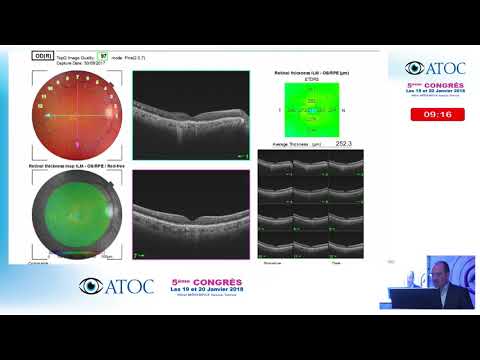 Conférence Salle 1 : Rétine Médicale DMLA vidéo 5