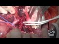 Extended left hepatectomy for hilar cholangiocarcinoma