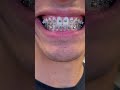 Painful Braces Removal…
