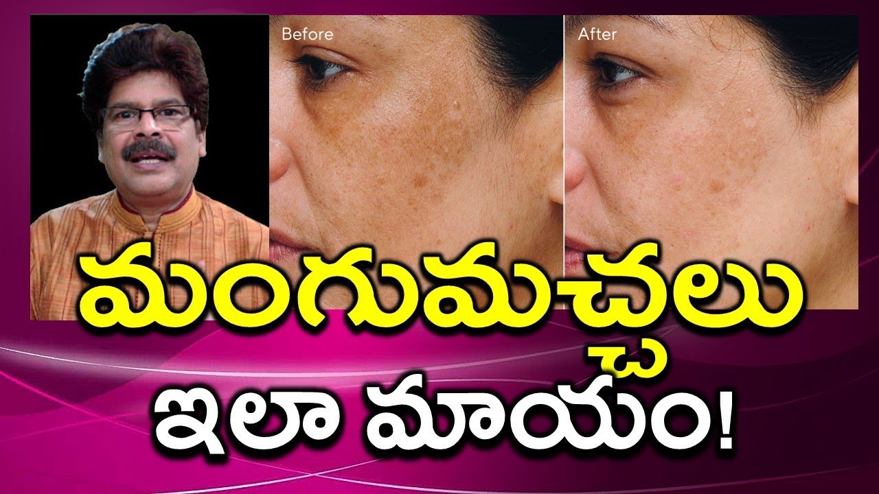 మంగుమచ్చలను మాయం చేసే ఇంటివైద్యం. Simple Remedies for  Hyper pigmentation by Dr. Murali Manohar MD