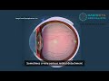 Dr kenneth fong  retinal detachment