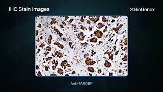 Melanoma Tumor Panel Awareness Month Melanoma Tumor Markers Biogenex