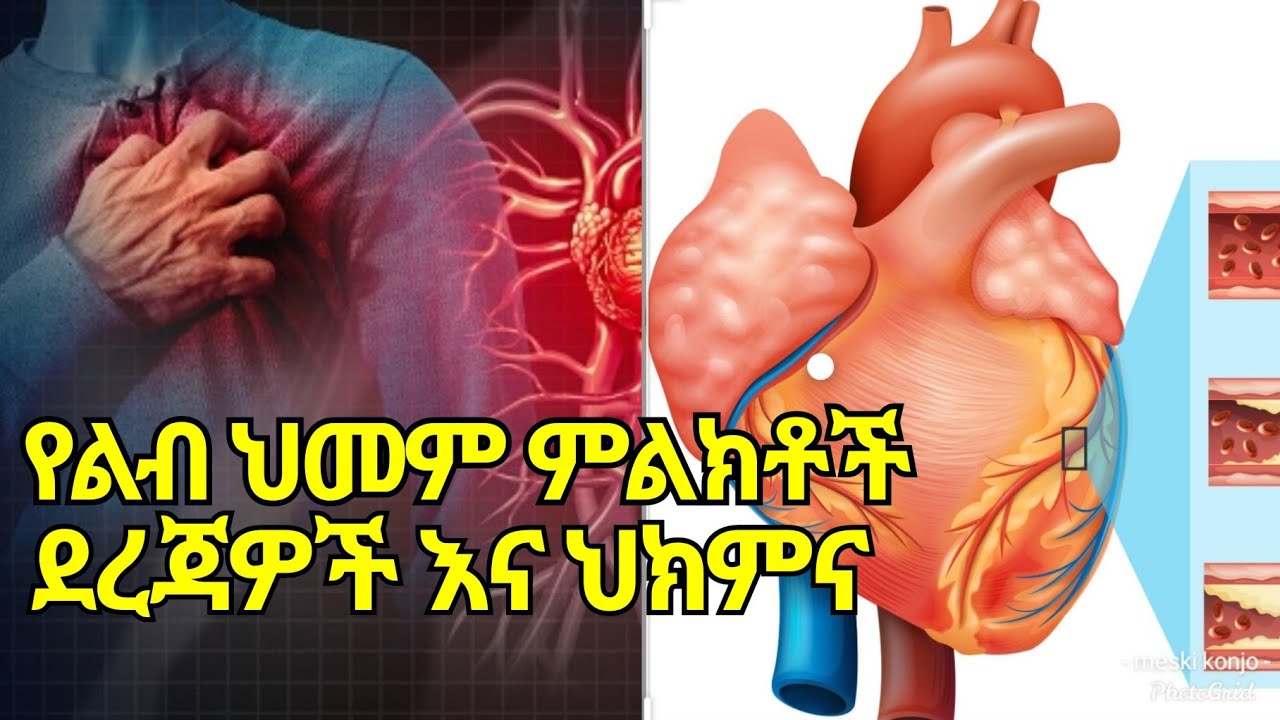 የልብ ህመም ምልክቶች ደረጃዎችና ህክምናቸው ከ ዶክተር አለ // levels of  Heart disease