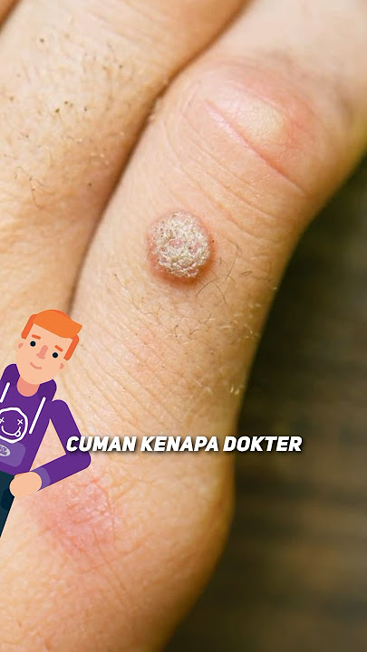 BERBAHAYA GUYS! Ternyata Inilah Alasan Mengapa Kutil Tidak Boleh Langsung Dipotong! 🤯😩