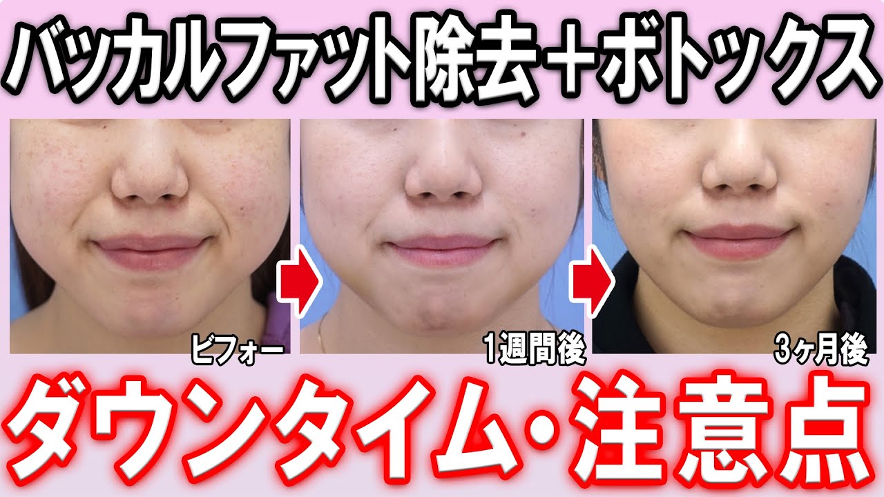 小顔になりたいなら脂肪と筋肉を攻めろ バッカルファット エラボトックス特集 湘南美容クリニック Youtube 小顔になりたいなら脂肪と筋肉を攻めろ バッカルファット エラボトックス特集 湘南美容クリニック Youtube