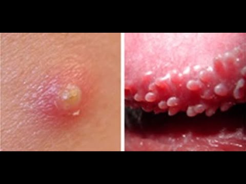 pearly penile papules co2 laser, pearly penile papules cure reddit, pearly ...