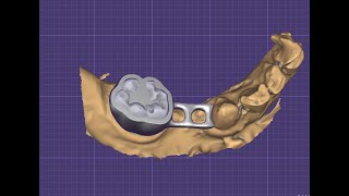 How To Design Space Maintainer By Exocad. تصميم حافظة مسافة باستخدام اكسوكاد