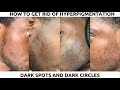 HOW TO GET RID OF HYPERPIGMENTATION, DARK SPOTS AND DARK CIRCLES