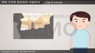 [시연용] c0149aako 위턱 구치부 임프란트 식립안내 1단계수술