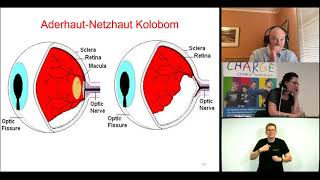 David Brown -Q&A- Visual issues for people with CHARGE syndrome / CHARGE-Conference 2021