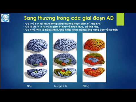 Thuốc điều trị Sa sút trí tuệ Alzheimer - TS Trần Công Thắng