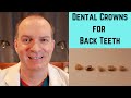 Back Tooth Dental Crown Options 🦷