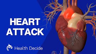 Heart Attack - Myocardial Infarction - 3D Animation