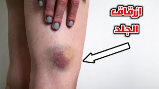 لية بيظهر ازرقاق في الجلد وخصوصا للنساء_ How do bruises appear for women for no reason?